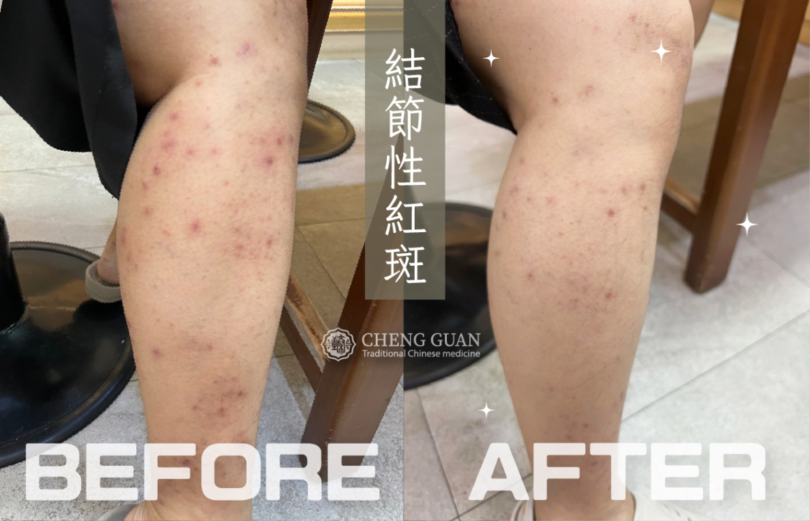 吳淳惠 結節性紅斑_官網-腳