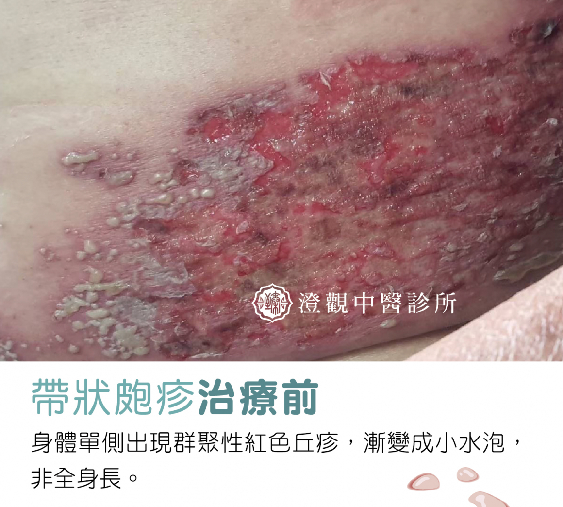 圖十二-帶狀皰疹正方形分四格-01 圖十二-帶狀皰疹正方形分四格-01