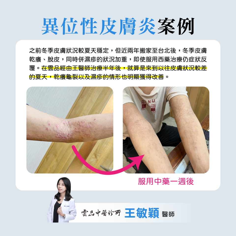 20240704_雲品_王敏穎_異位性皮膚炎 25歲男性 20240704_雲品_王敏穎_異位性皮膚炎 25歲男性