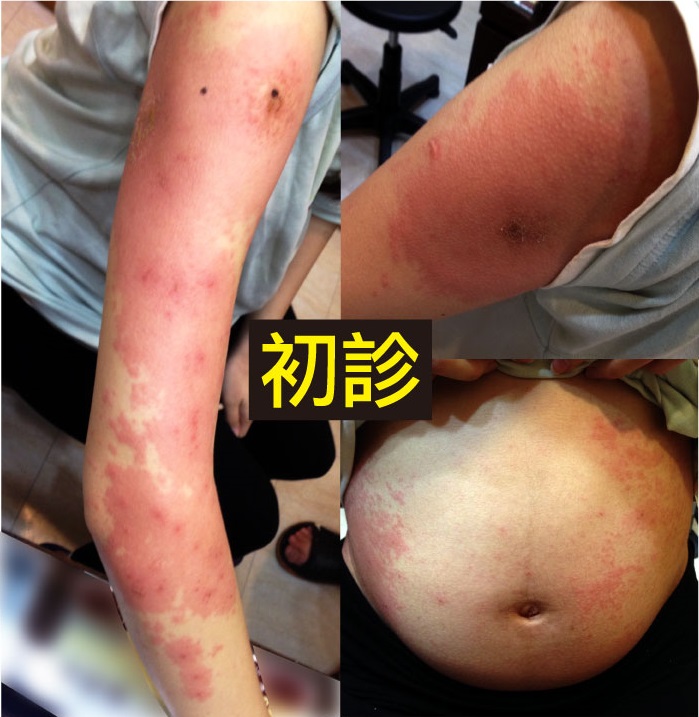 初診照片