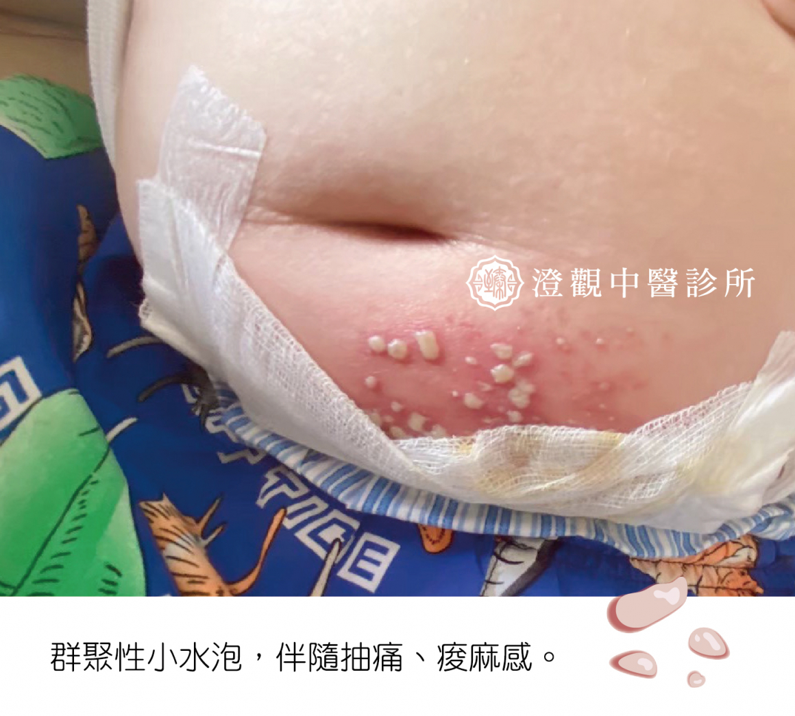 圖十二-帶狀皰疹正方形分四格-02 圖十二-帶狀皰疹正方形分四格-02