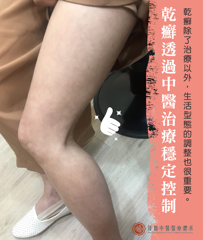 圖 片 二 -乾癬 分成兩張-06