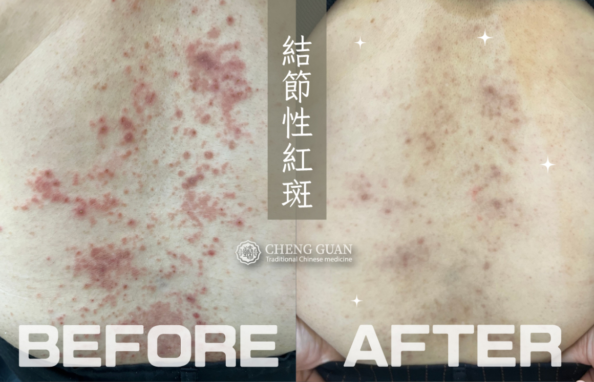 吳淳惠 結節性紅斑_官網-背