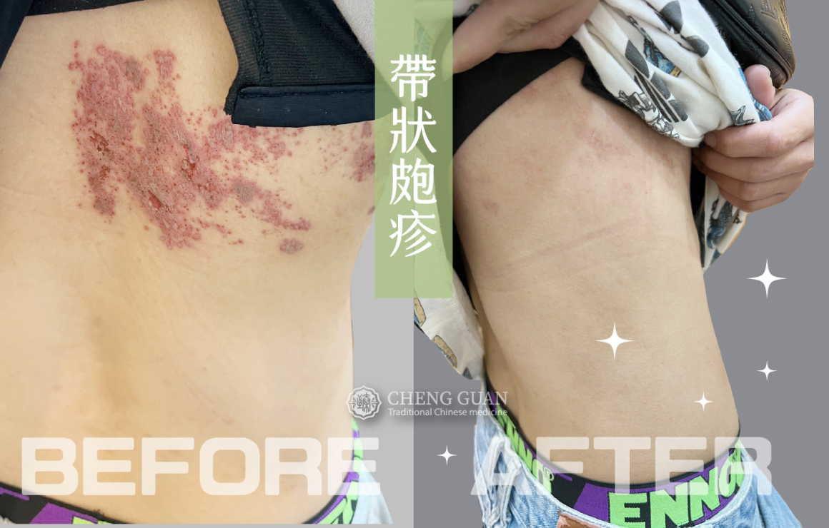 圖四.帶狀皰疹 _345X220