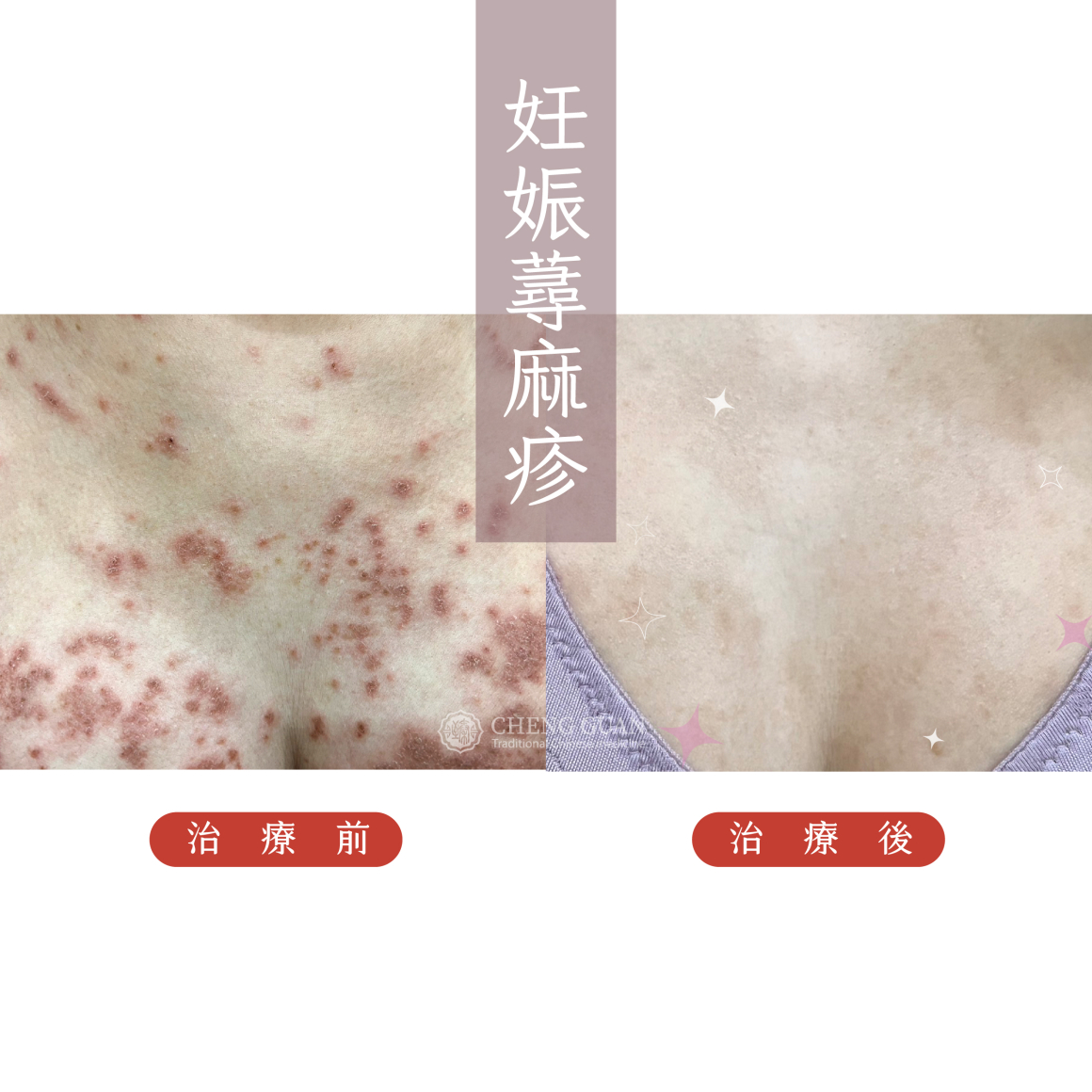 妊娠蕁麻疹  (2)