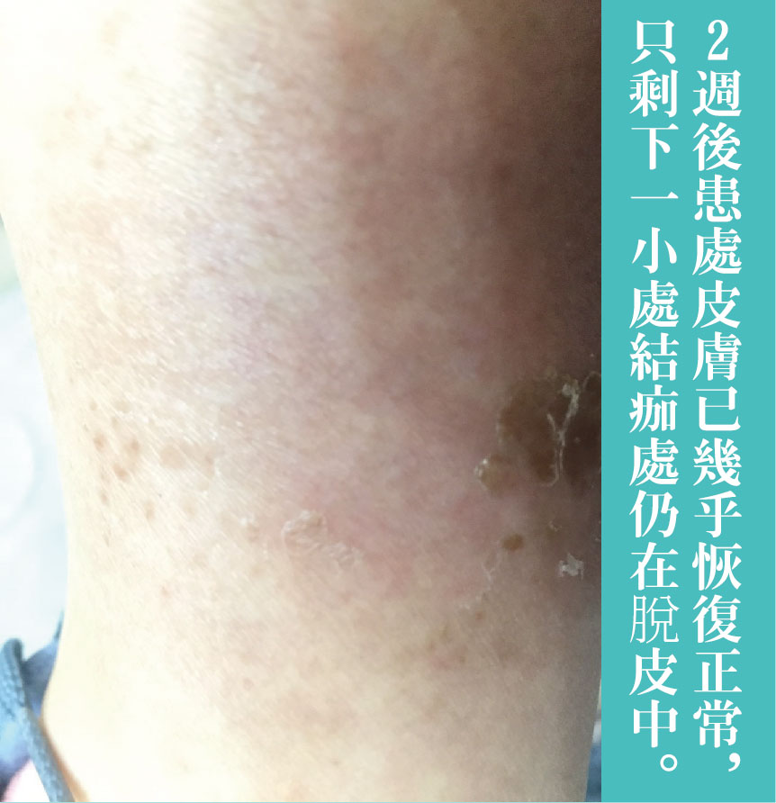 治療過程-04