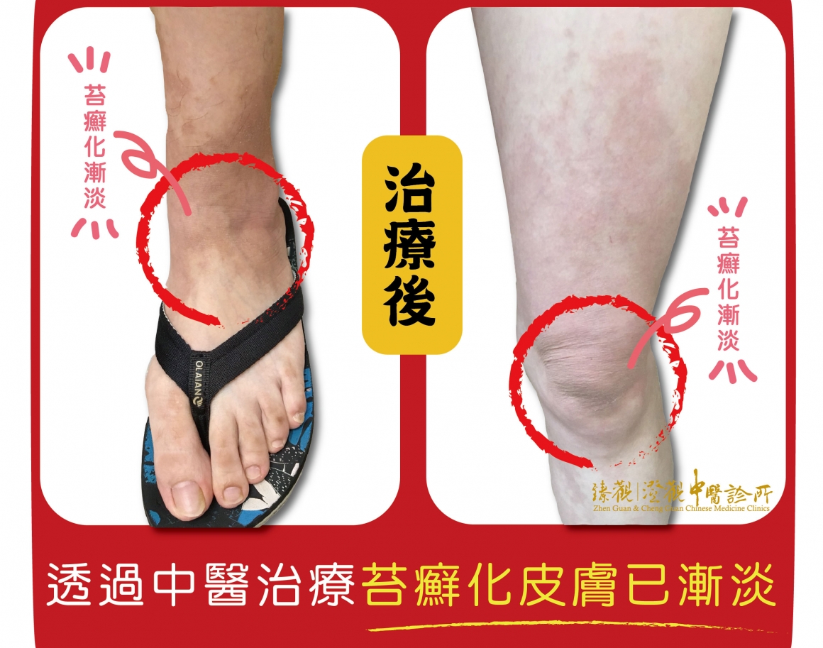濕疹反覆搔抓-02