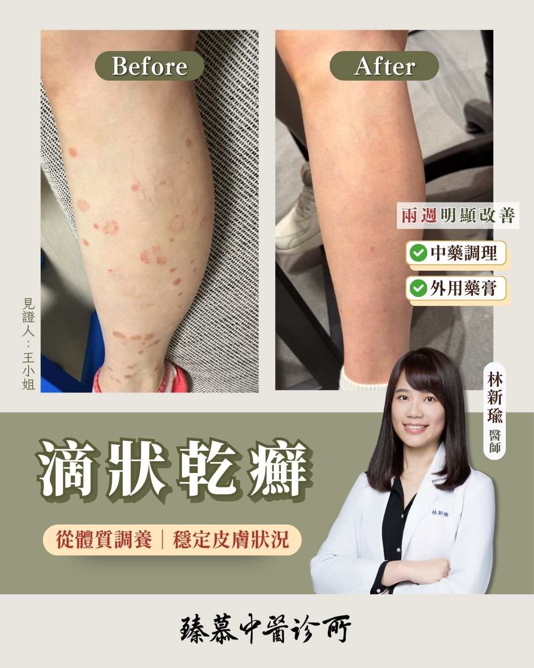 260126_Guttate Psoriasis_case_dr.lin