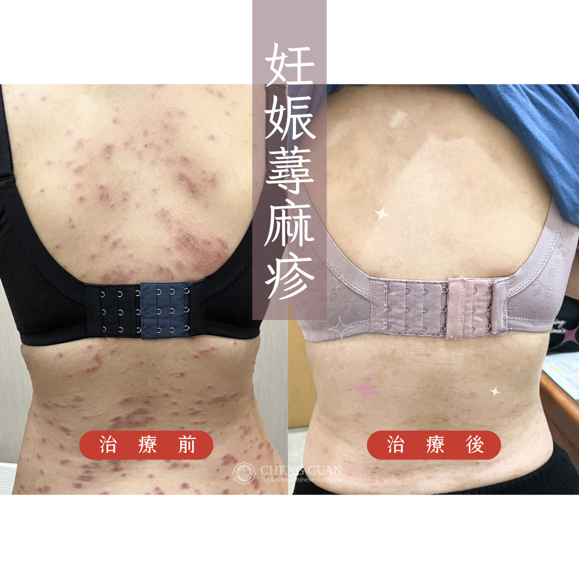 妊娠蕁麻疹  (3)