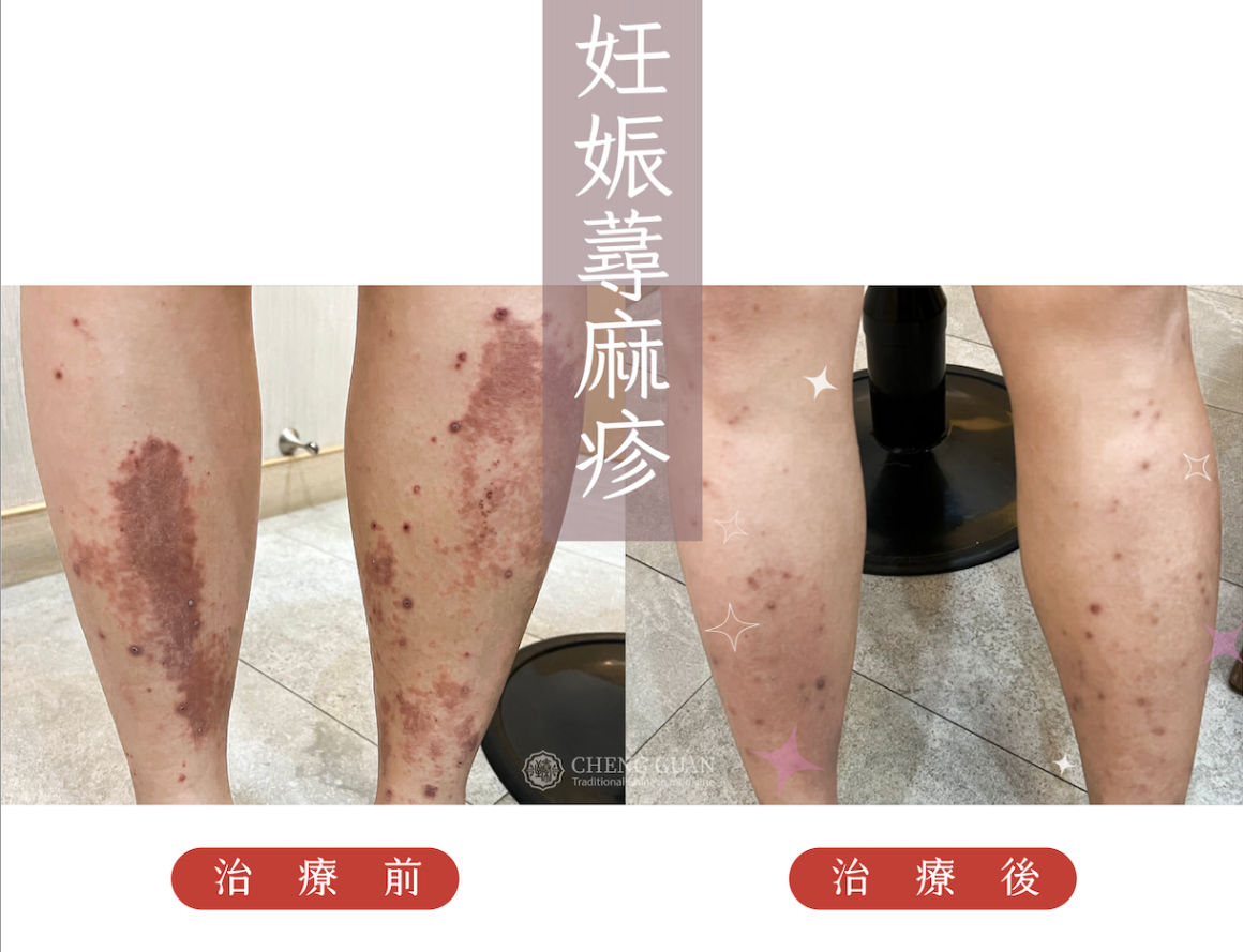 妊娠尋麻疹