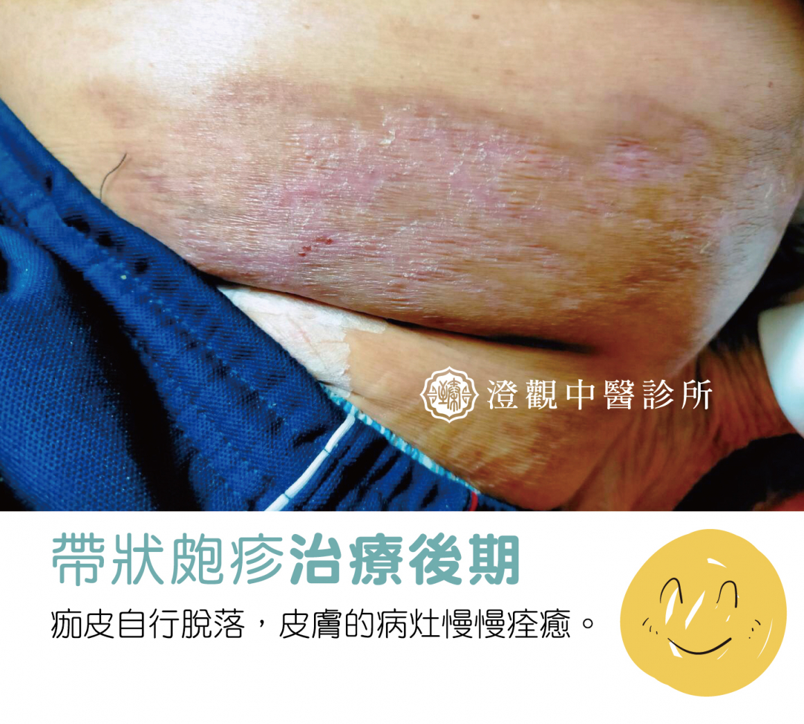 圖十二-帶狀皰疹正方形分四格-04 圖十二-帶狀皰疹正方形分四格-04