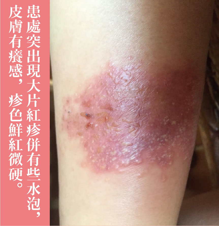 治療過程-02