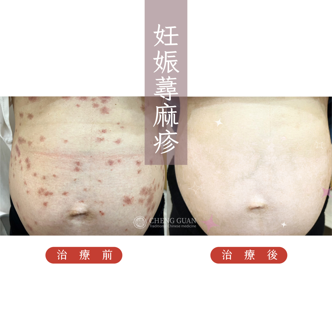 妊娠蕁麻疹  (1)