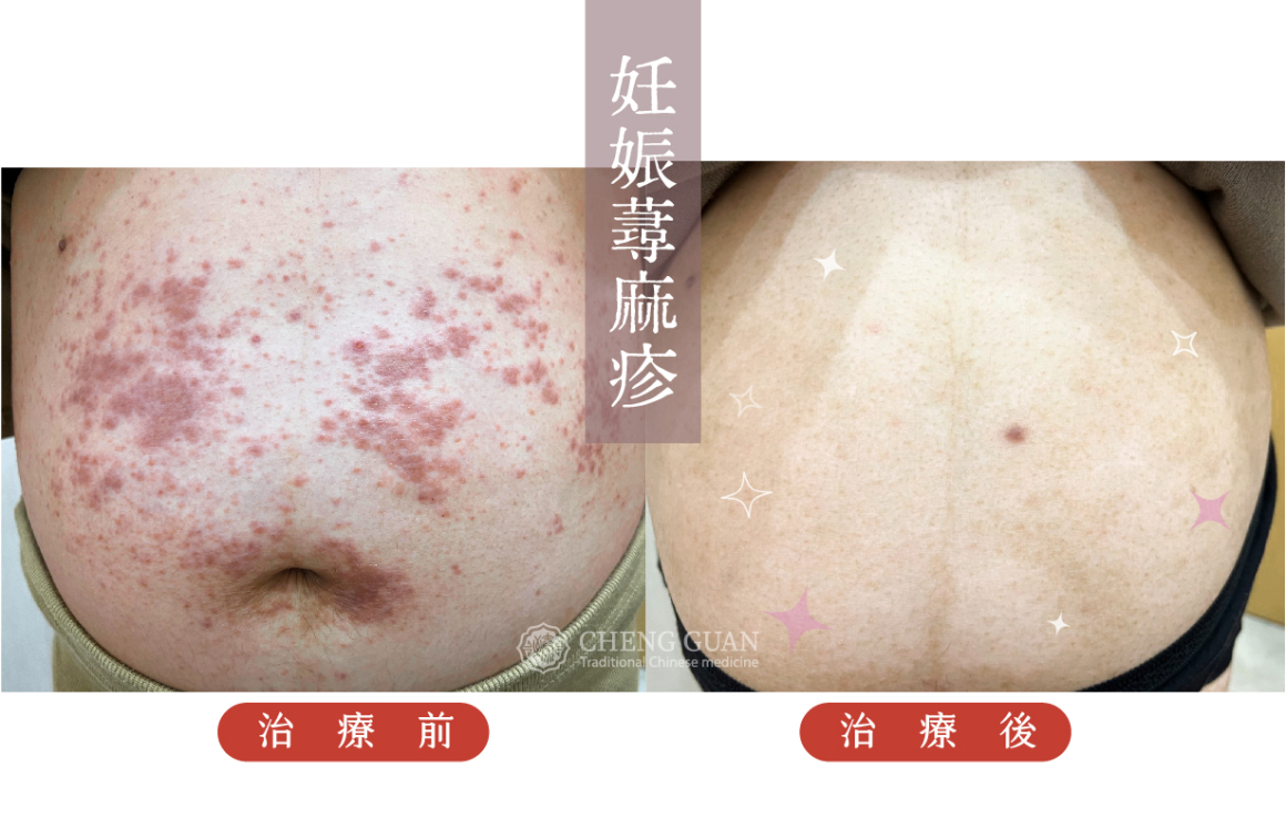 妊娠蕁麻疹 JPG-04
