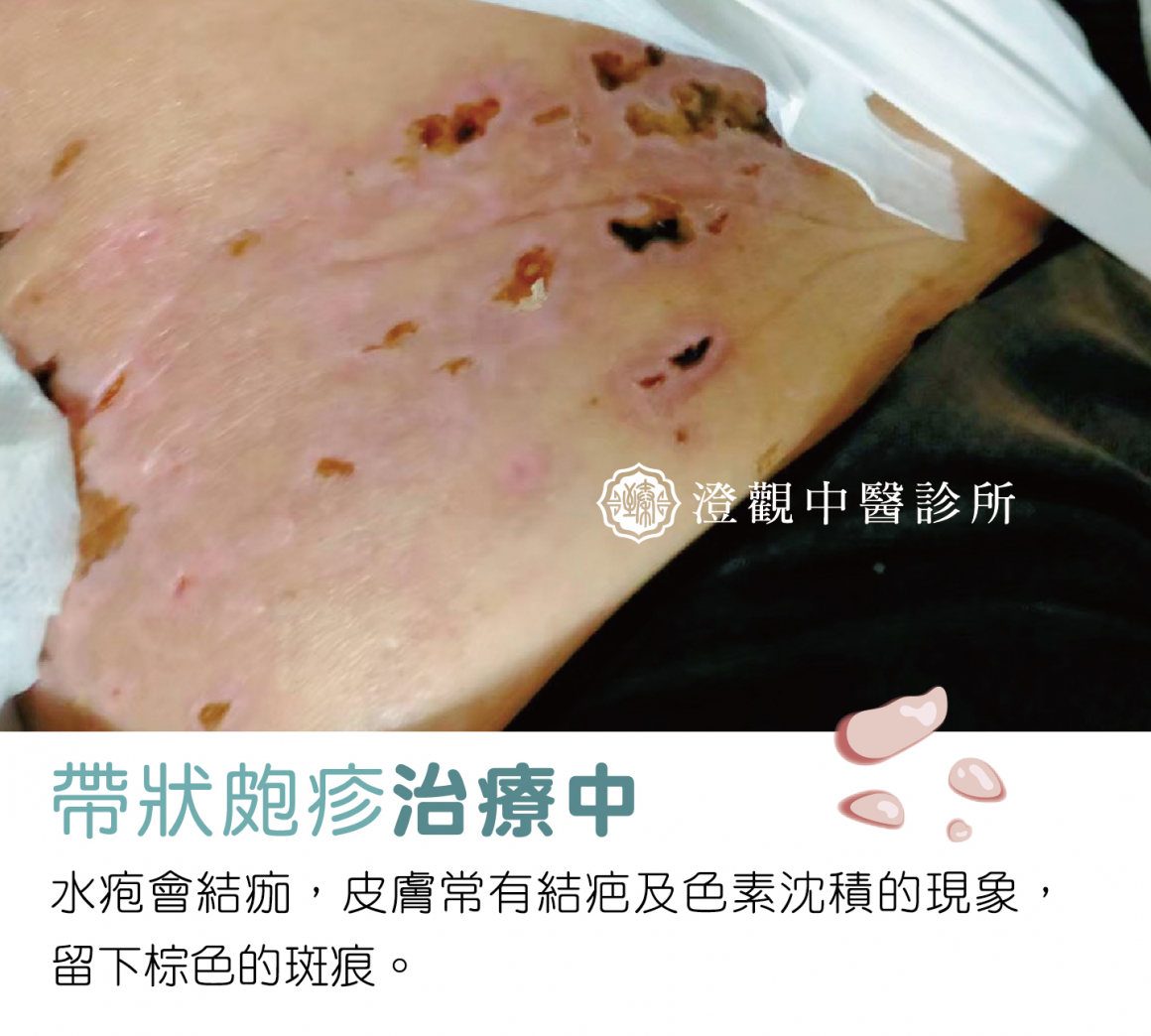 圖十二-帶狀皰疹正方形分四格-03 圖十二-帶狀皰疹正方形分四格-03