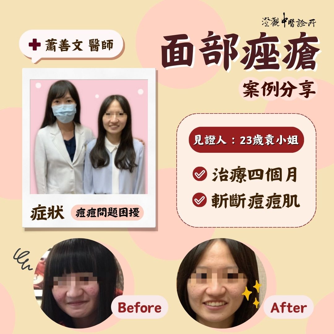 240624_Acne vulgaris_case 240624_Acne vulgaris_case