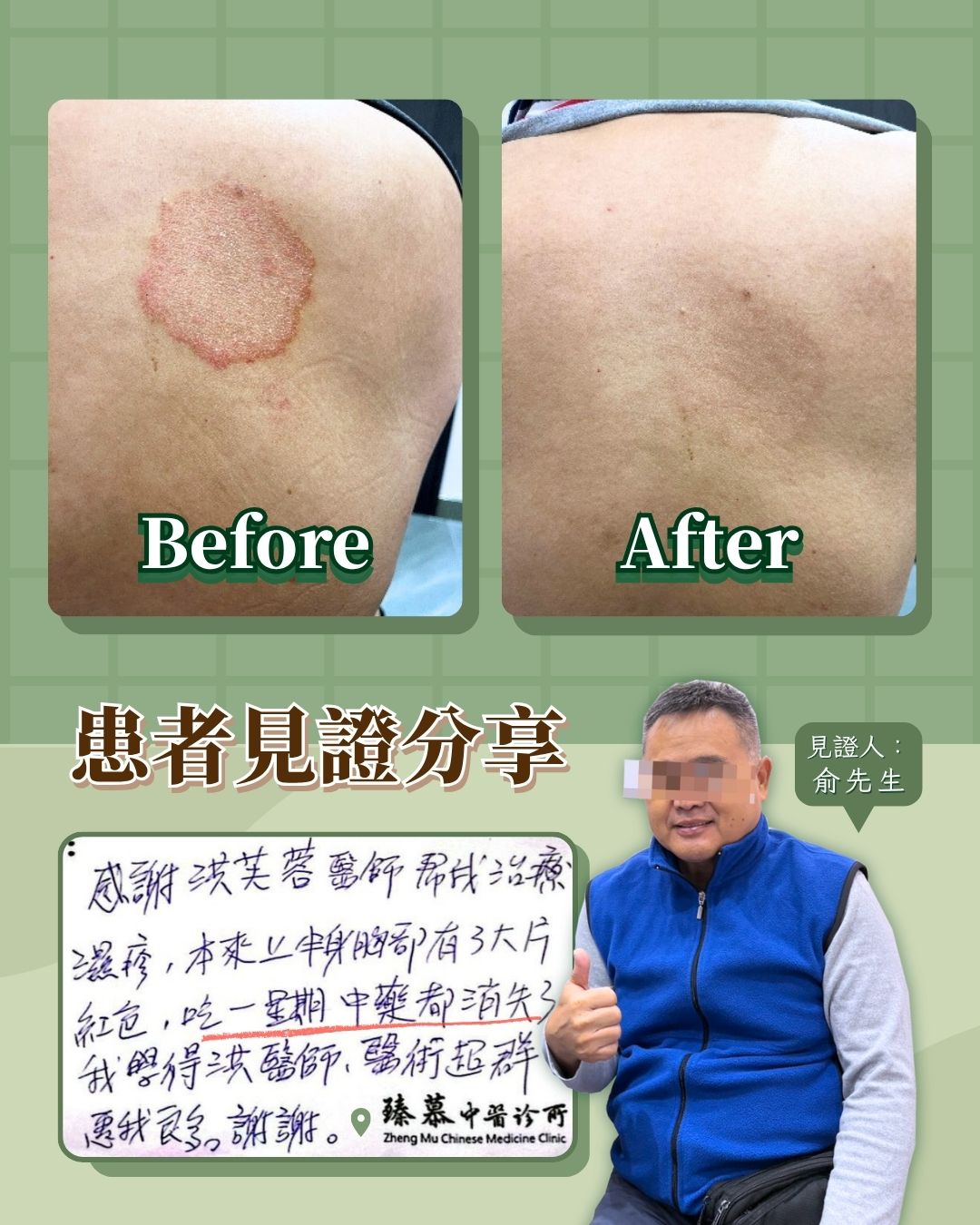 251104_Eczema_CASE_dr.hung_Experience 251104_Eczema_CASE_dr.hung_Experience