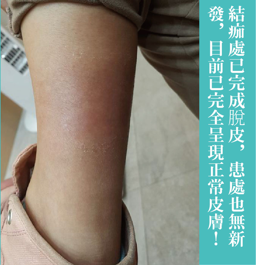 治療過程-05
