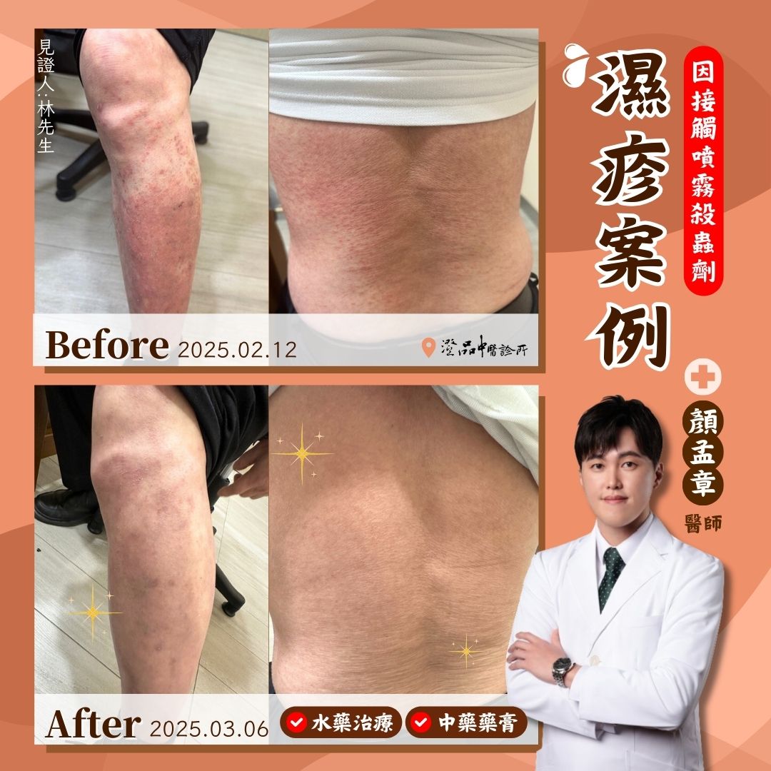 250411_eczema_case