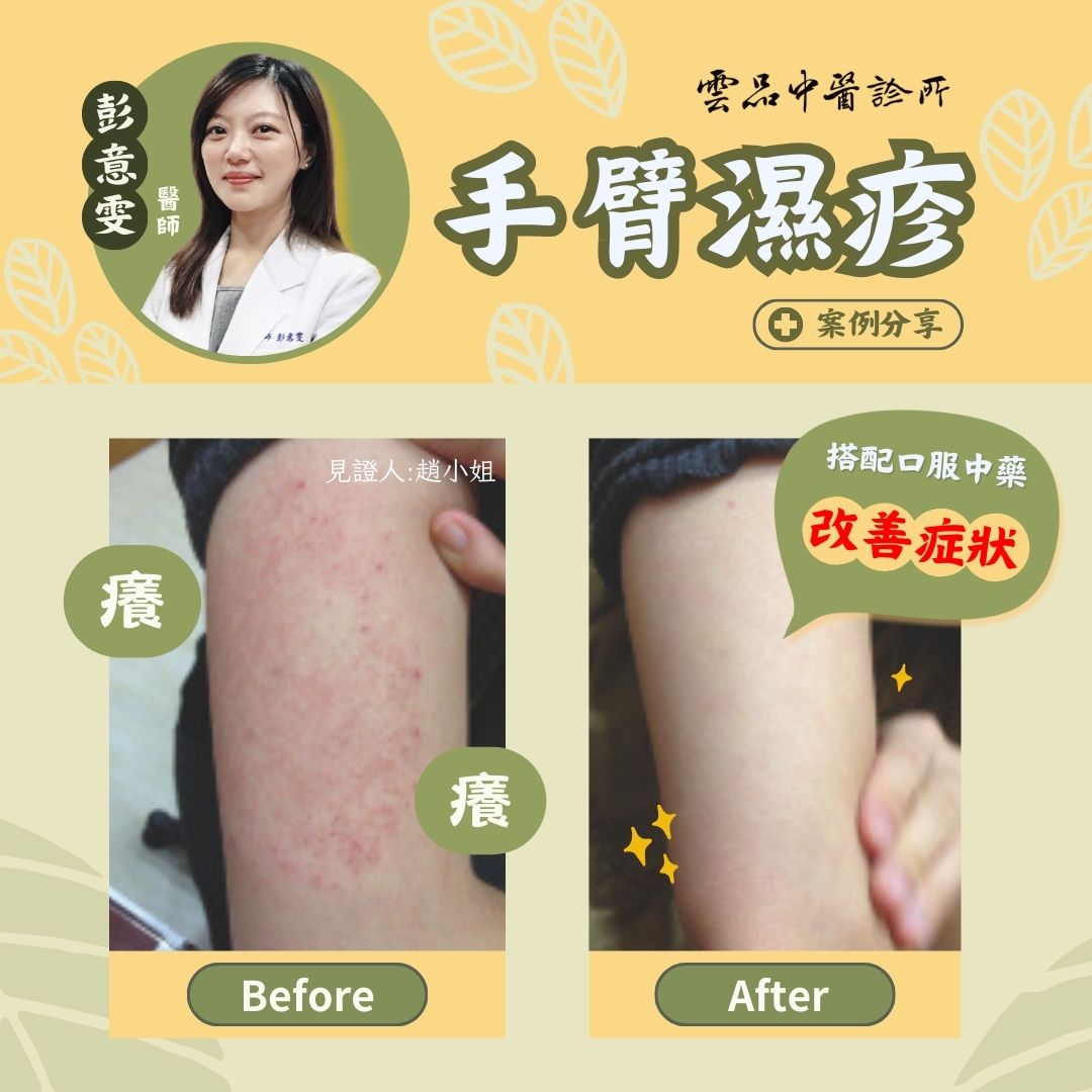 240927_arm_eczema_case_dr.yiwen 240927_arm_eczema_case_dr.yiwen