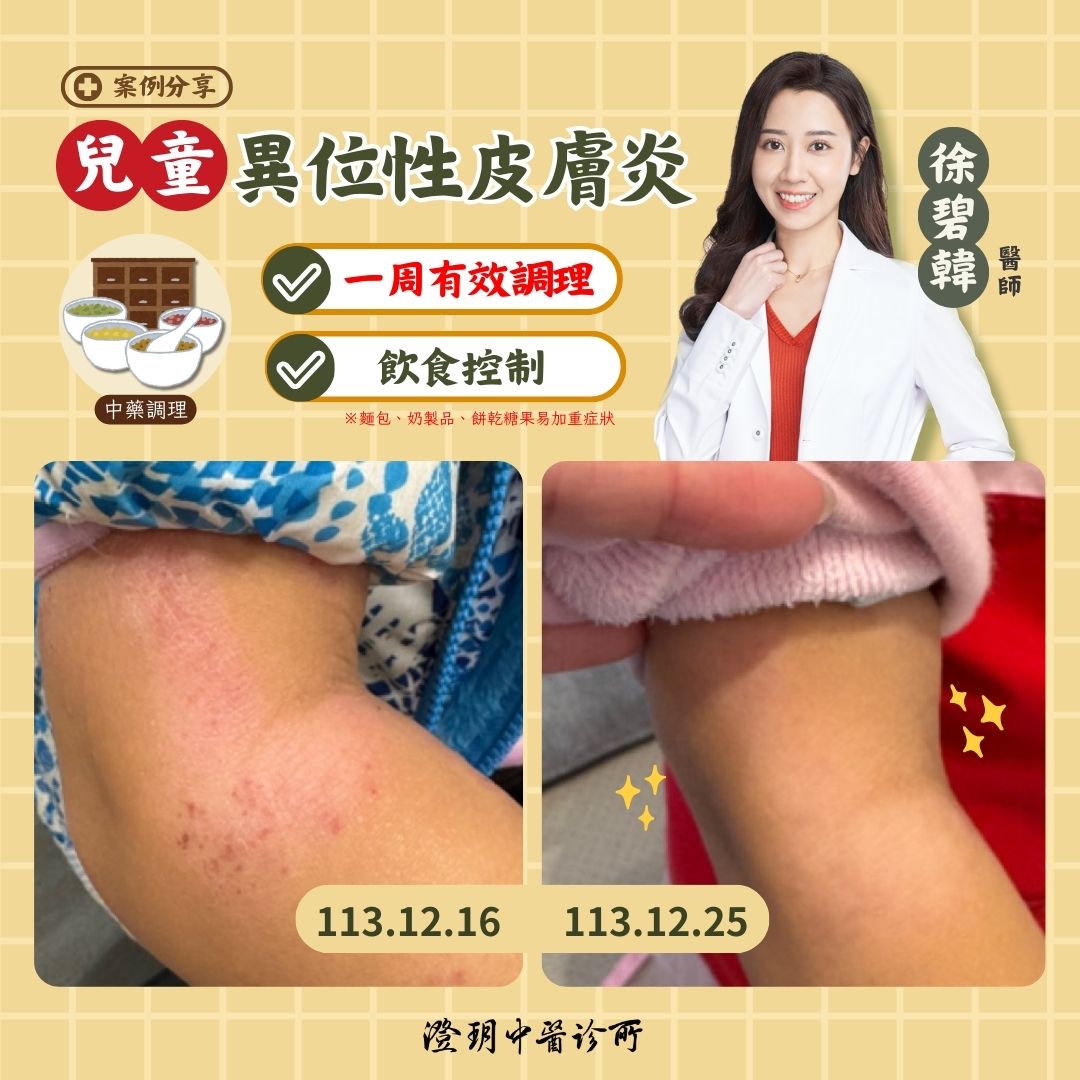 250111_atopic dermatitis_AD_case 250111_atopic dermatitis_AD_case