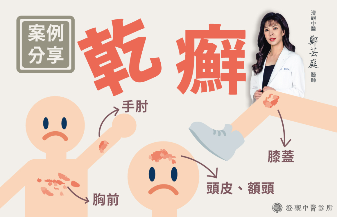 鄭芸庭 乾癬_官網-澄觀