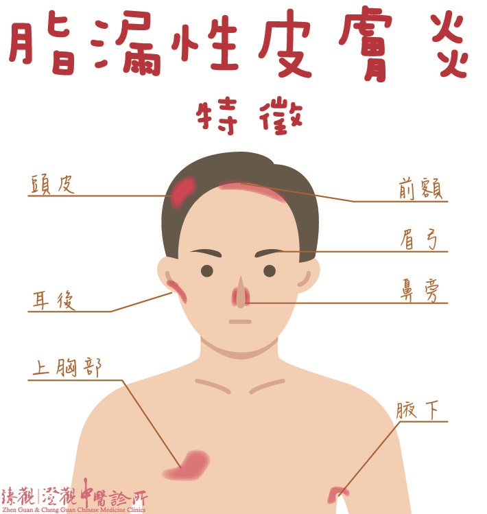 缺脂性皮膚炎的特徵-01