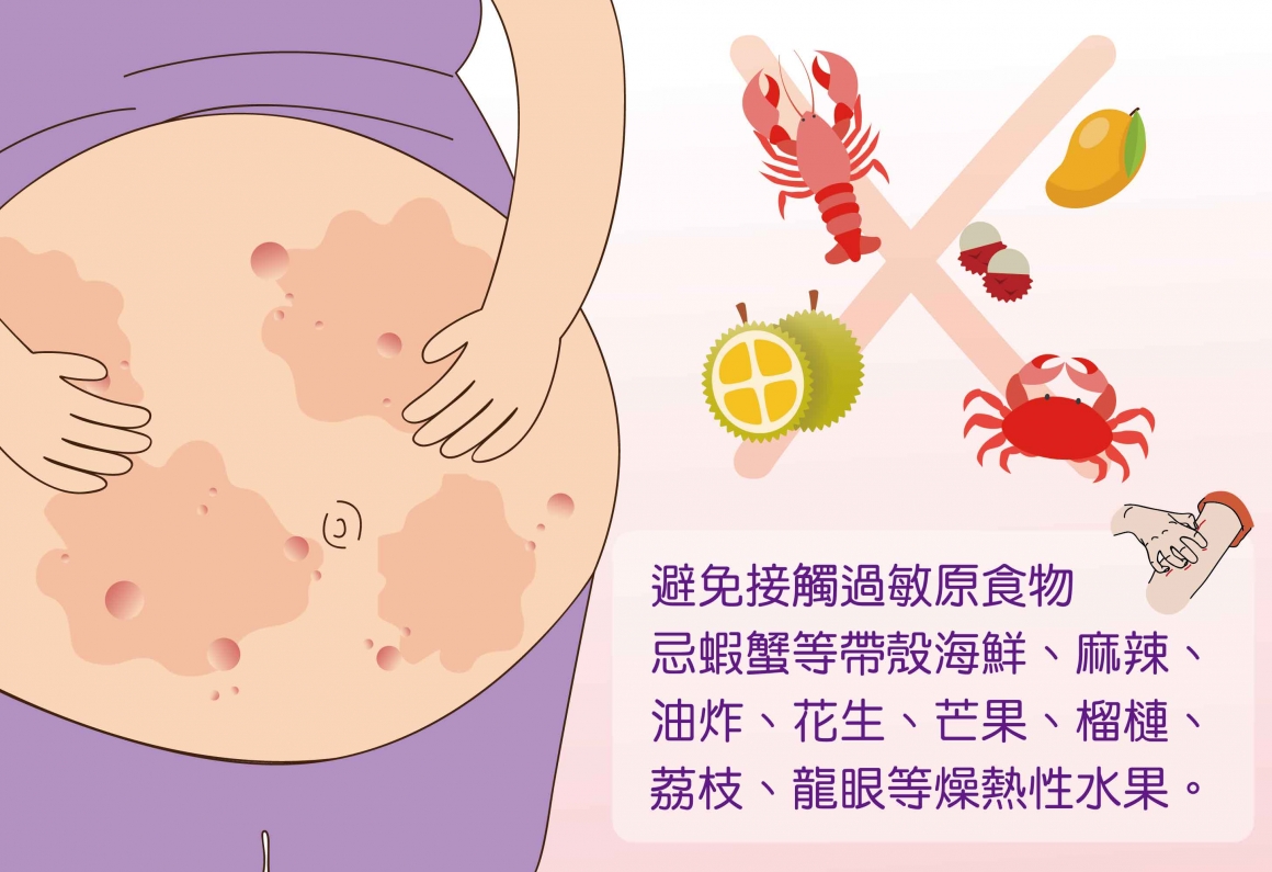 妊娠蕁麻疹-保健-01
