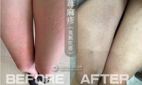 濕疹+蕁麻疹 │ 中醫皮膚專科
