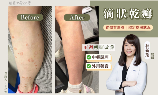 滴狀乾癬｜皮膚專科｜臻慕中醫  林新瑜醫師