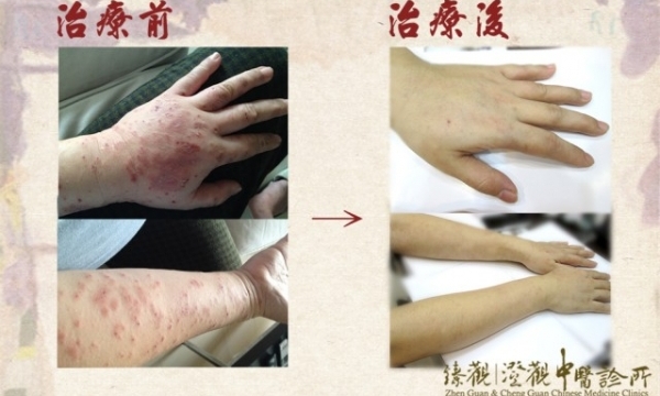 【妊娠蕁麻疹】臻觀中醫醫療體系醫師群