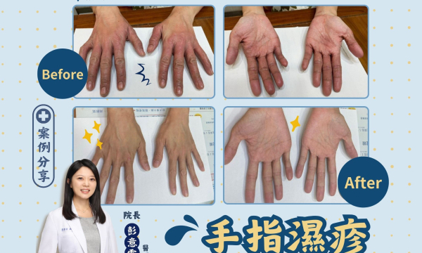 【手指型濕疹_林小姐】案例分享｜雲品中醫 院長彭意雯 醫師
