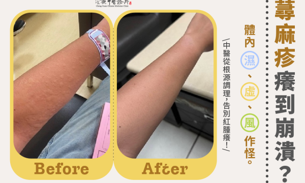 慢性蕁麻疹│澄觀中醫台中 林怡君醫師