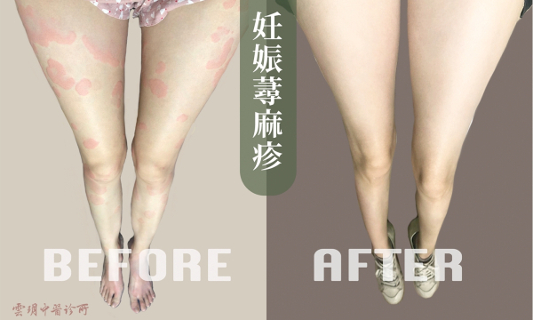 [妊娠蕁麻疹] 精誠澄觀中醫