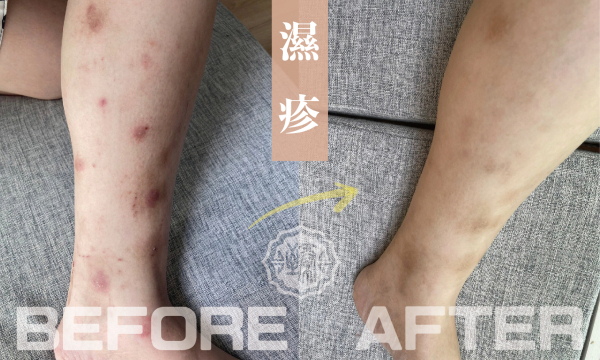【濕疹+蕁痲疹】精誠澄觀中醫