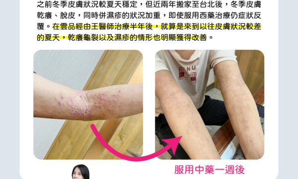 大面積異位性皮膚炎案例｜雲品中醫 王敏穎醫師