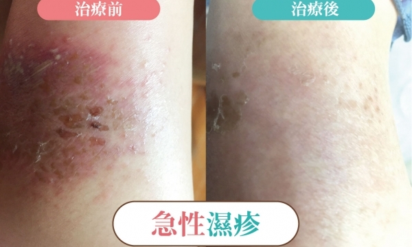 【急性濕疹】精誠澄觀中醫