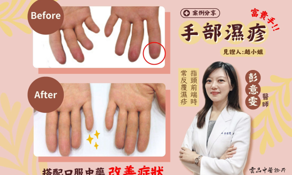【手部濕疹_趙小姐】案例分享｜雲品中醫 院長彭意雯 醫師