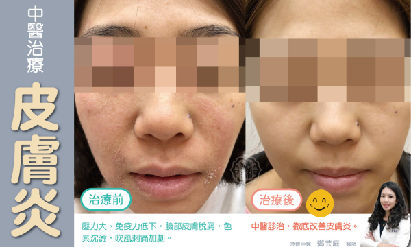 皮膚炎│澄觀中醫 鄭芸庭醫師