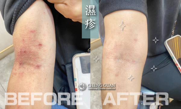 濕疹 │皮膚專科 │澄觀中醫 林怡君醫師