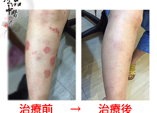 【皮膚搔癢 見證人:沈小姐】澄品中醫 中和院區  副院長 周玟安醫師
