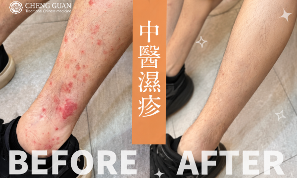 濕疹反覆發作？中醫穩定膚況│澄觀中醫 陳梓頤醫師
