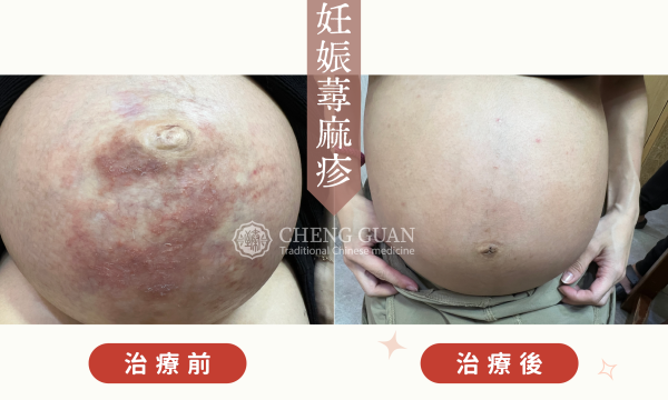 妊娠蕁麻疹│澄觀中醫 吳淳惠院長