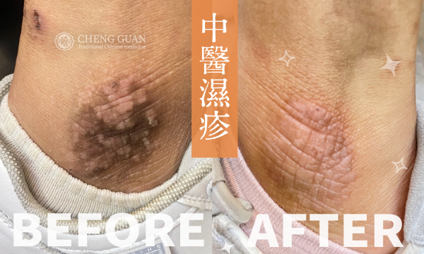 濕疹 │ 皮膚專科 │澄觀中醫 林怡君醫師