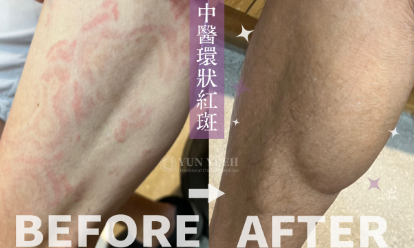 環狀紅斑│皮膚專科│精誠澄觀中醫