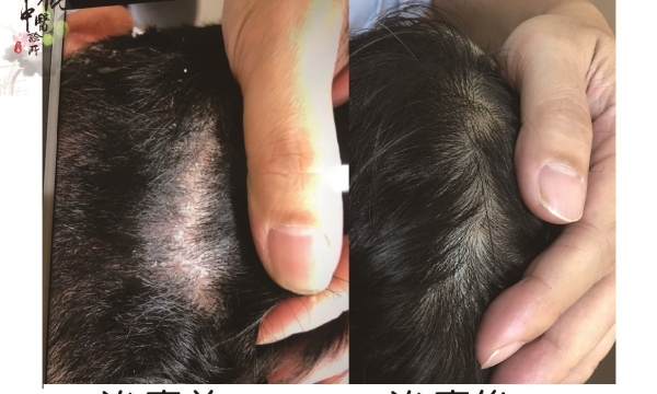 【脂漏性皮膚炎】精誠澄觀中醫