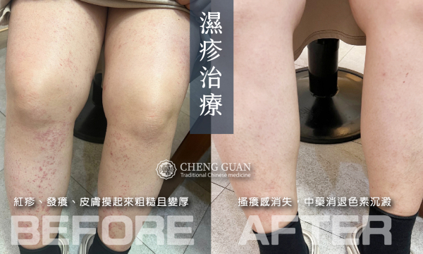 濕疹 │ 皮膚專科 │ 澄觀中醫 吳淳惠院長