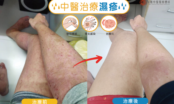 【濕疹】 澄觀中醫(台中)醫師群