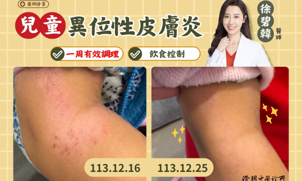 【兒童異位性皮膚炎_簡妹妹】案例分享｜澄玥中醫 徐碧韓 醫師