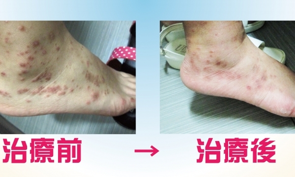 【妊娠蕁麻疹】澄觀(台北) 院長 蕭善文醫師